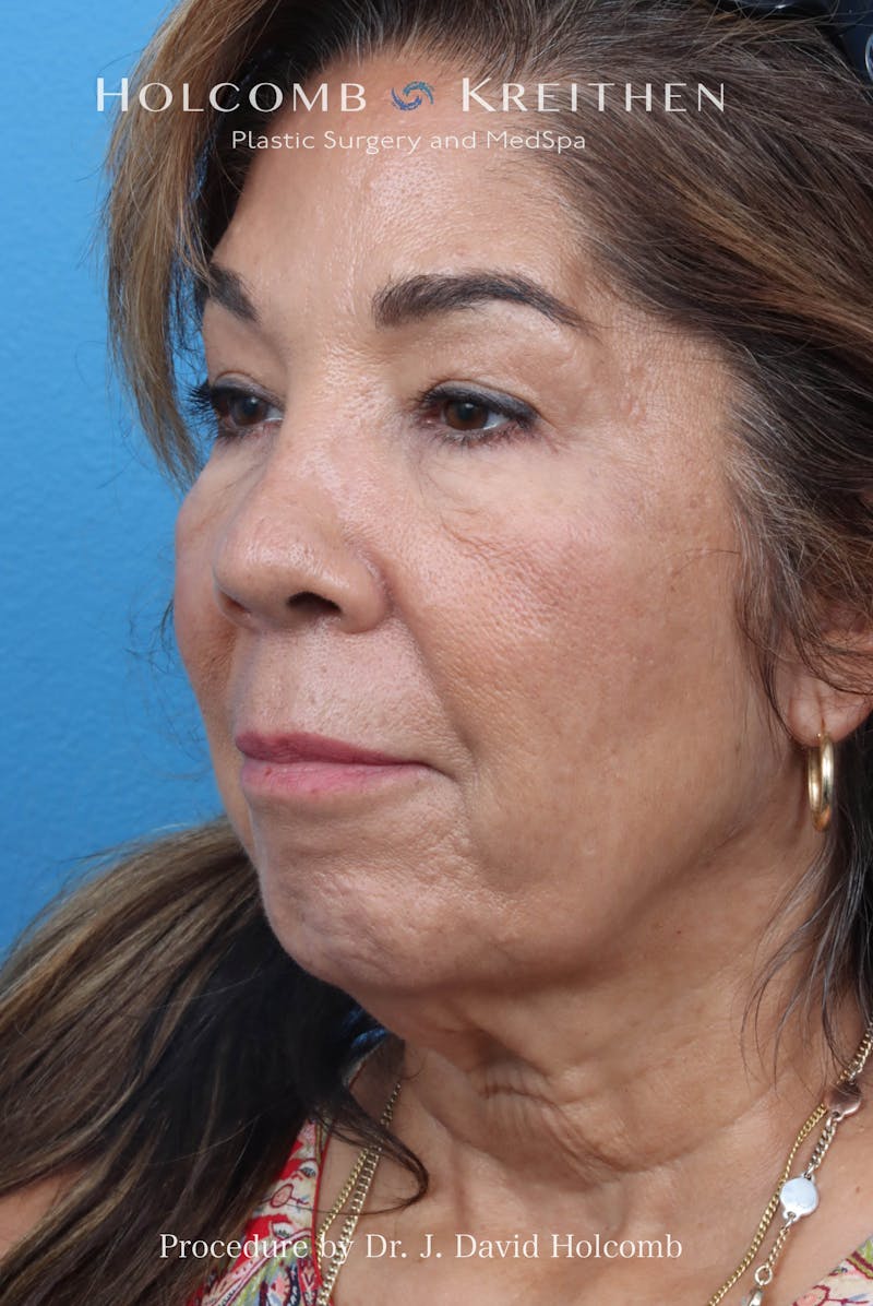 Facelift Before & After Gallery - Patient 124002 - Image 7