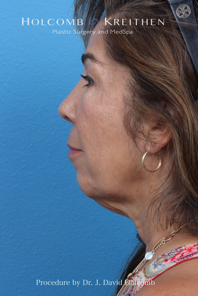 Facelift Before & After Gallery - Patient 124002 - Image 9