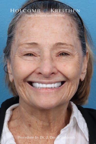 Facelift Before & After Gallery - Patient 860372 - Image 1