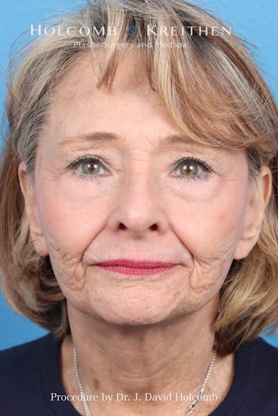 Facelift Before & After Gallery - Patient 860372 - Image 2
