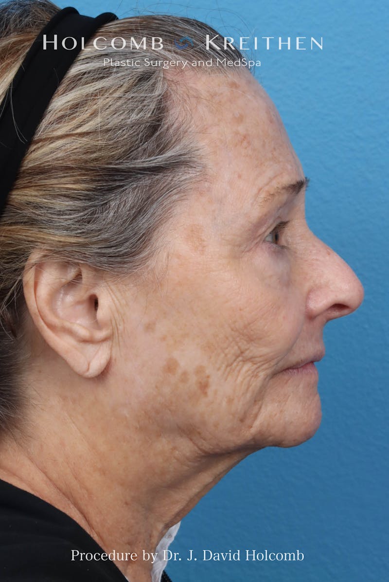 Facelift Before & After Gallery - Patient 860372 - Image 3