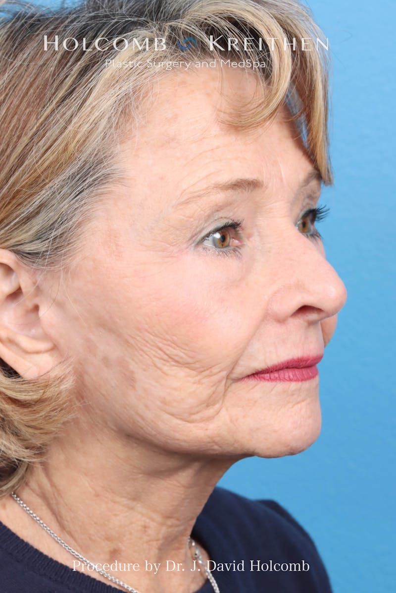 Facelift Before & After Gallery - Patient 860372 - Image 4