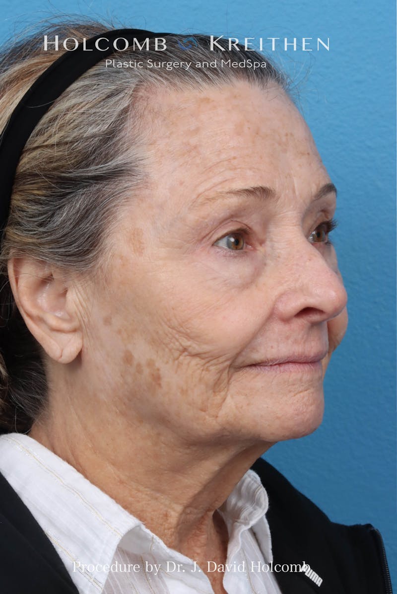 Facelift Before & After Gallery - Patient 860372 - Image 5