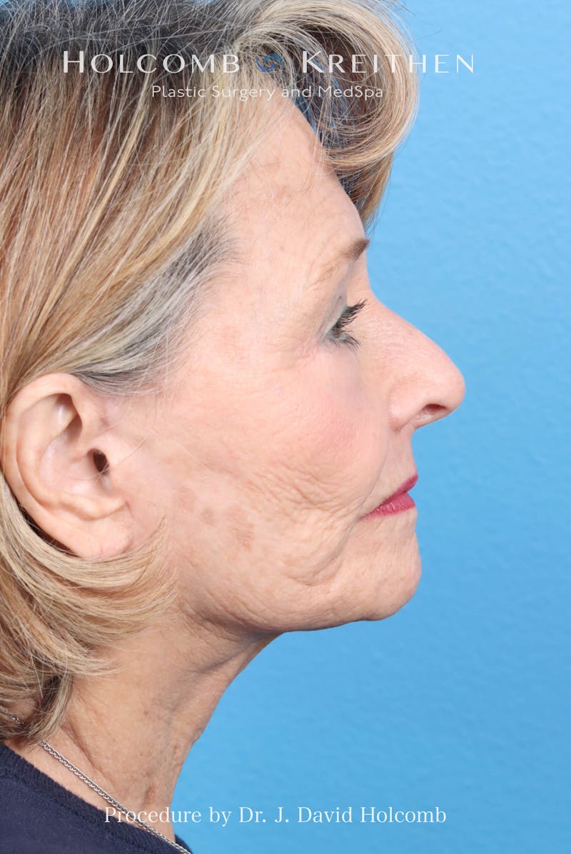 Facelift Before & After Gallery - Patient 860372 - Image 6