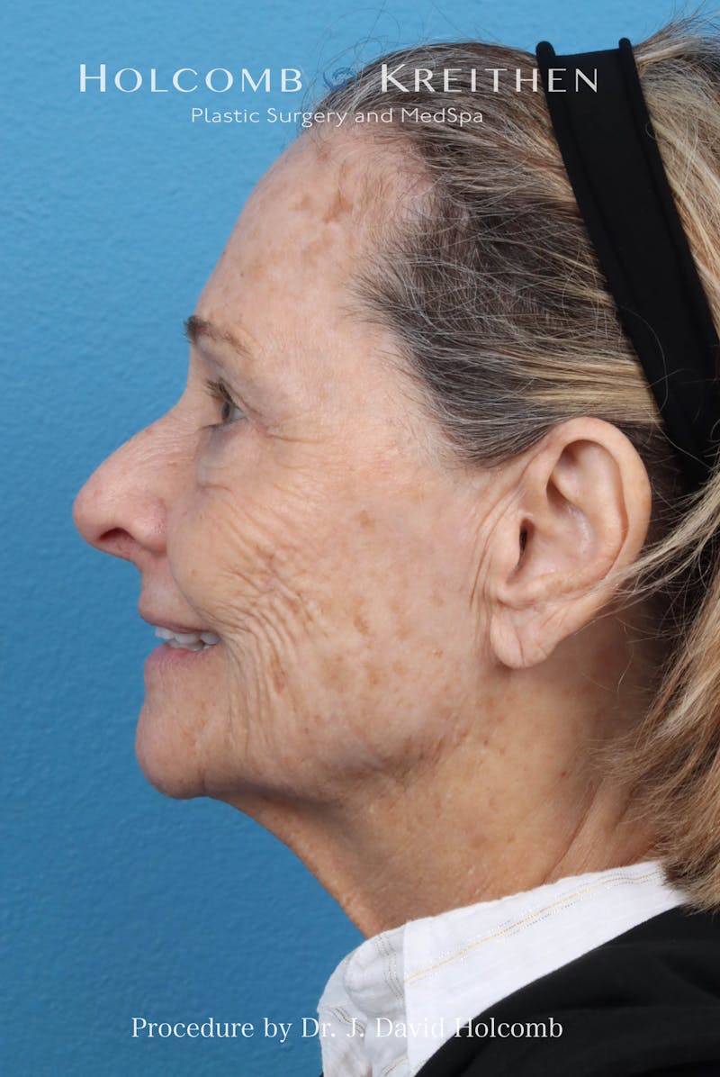 Facelift Before & After Gallery - Patient 860372 - Image 7