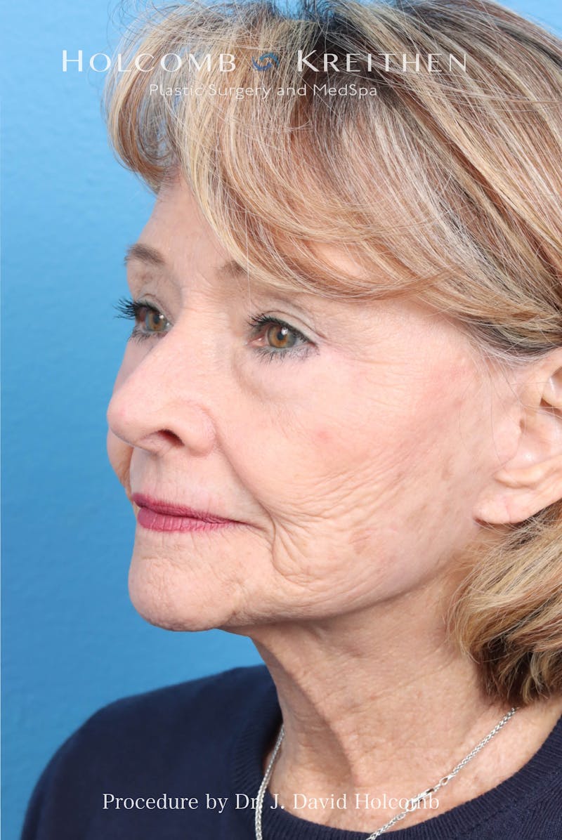 Facelift Before & After Gallery - Patient 860372 - Image 8
