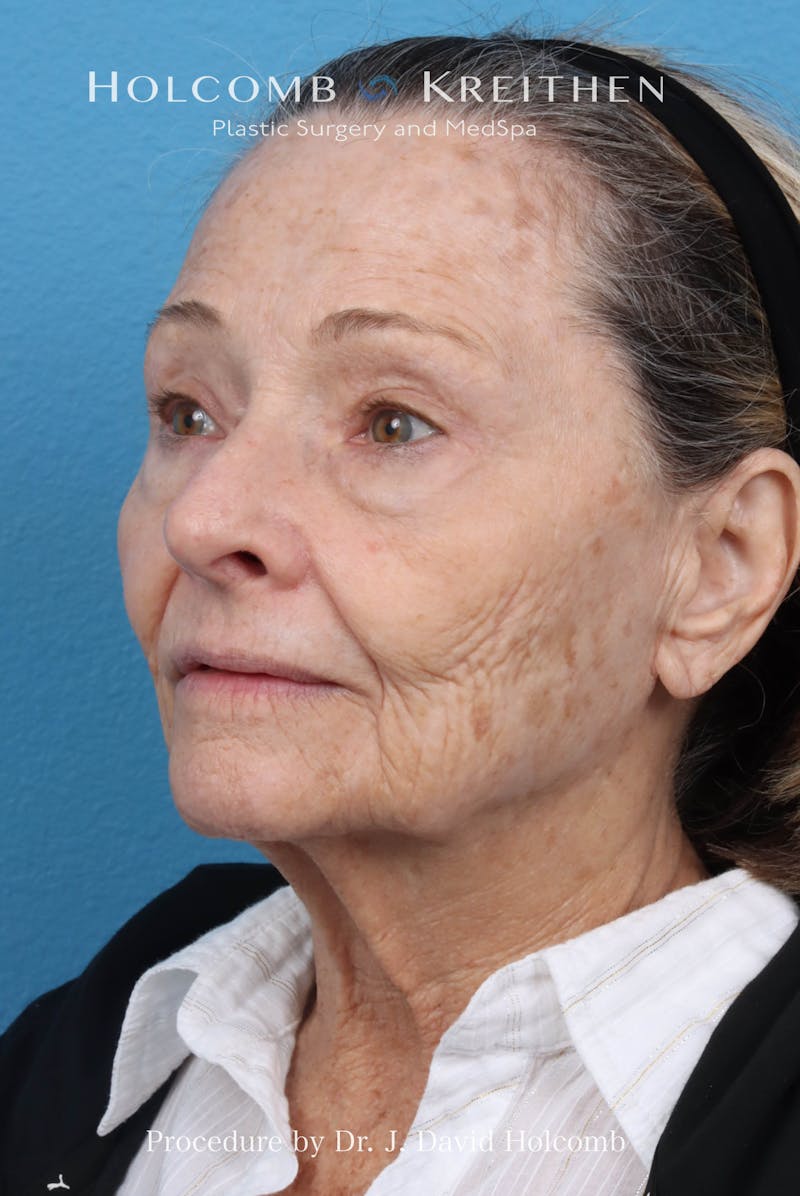 Facelift Before & After Gallery - Patient 860372 - Image 9