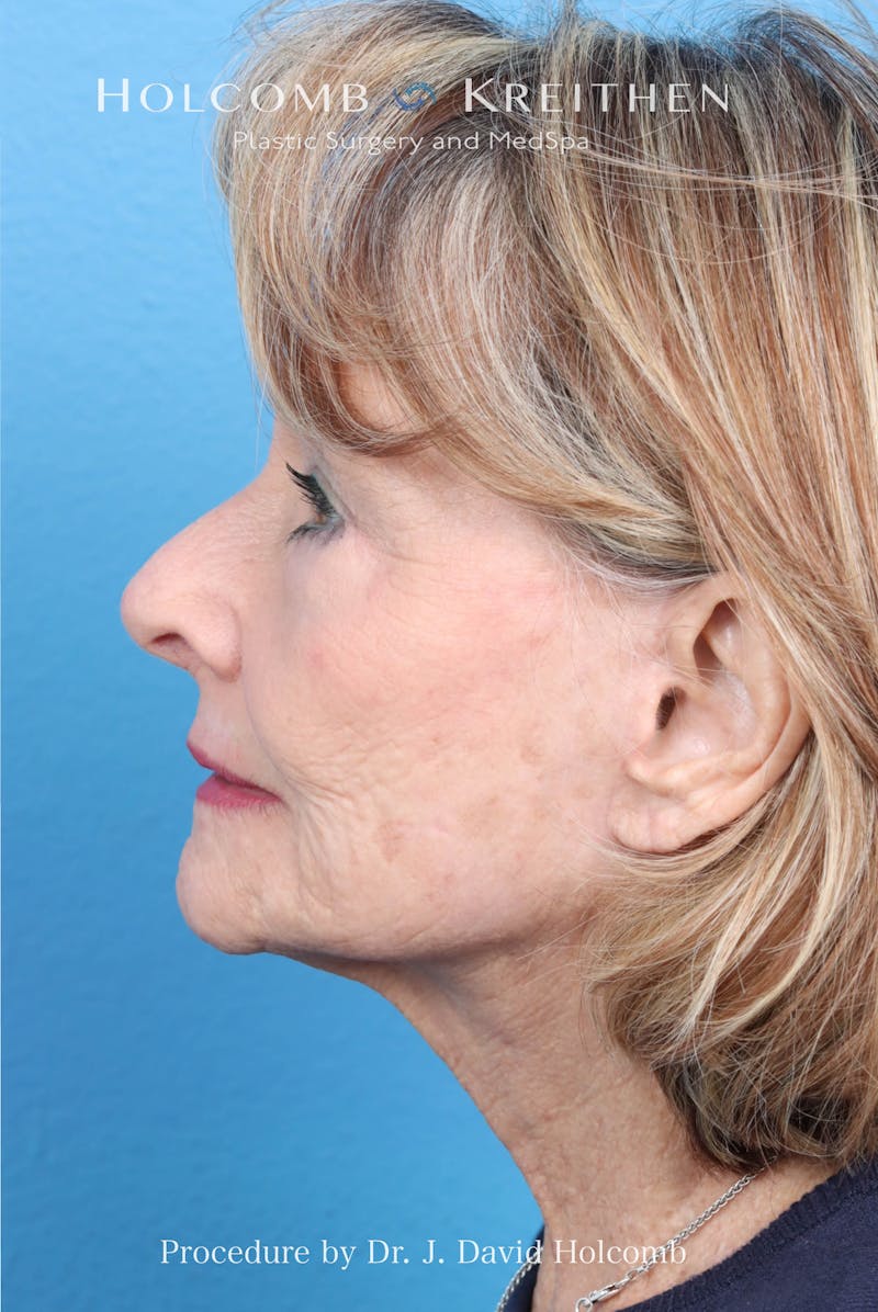 Facelift Before & After Gallery - Patient 860372 - Image 10