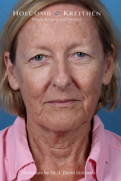 Facelift Before & After Gallery - Patient 410667 - Image 1