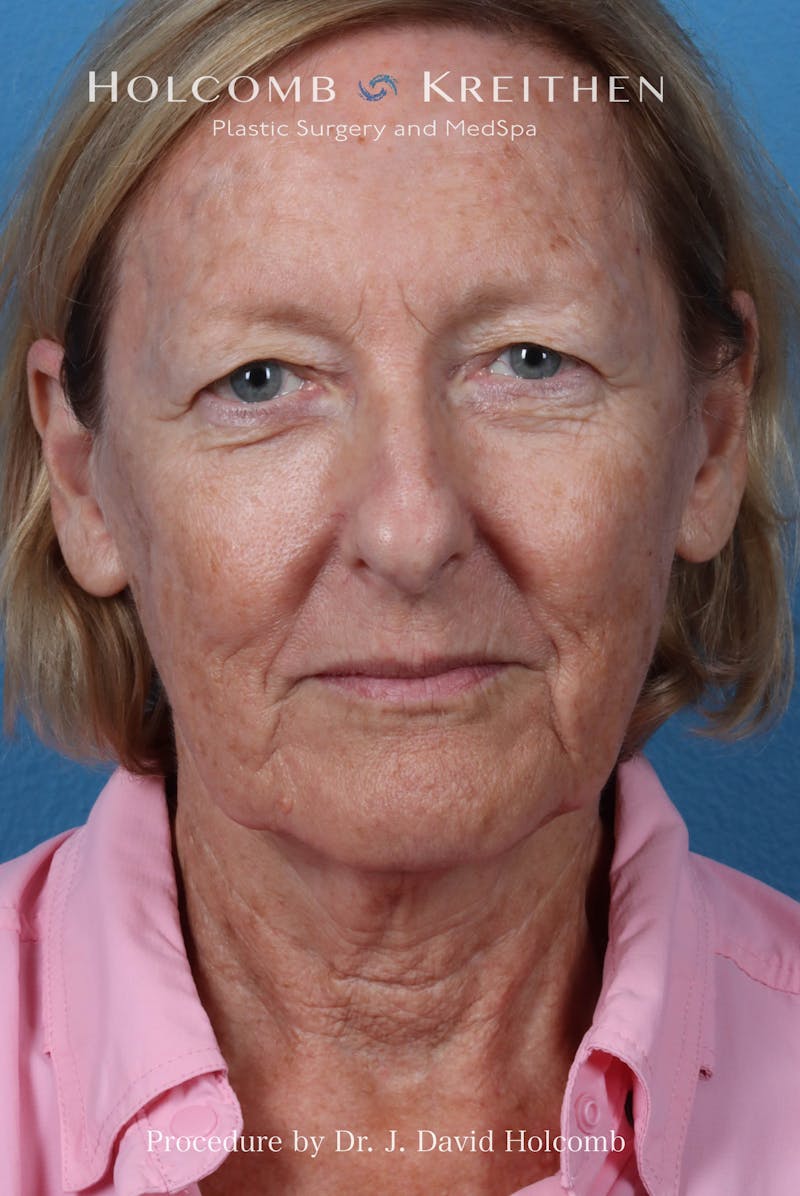 Facelift Before & After Gallery - Patient 410667 - Image 1