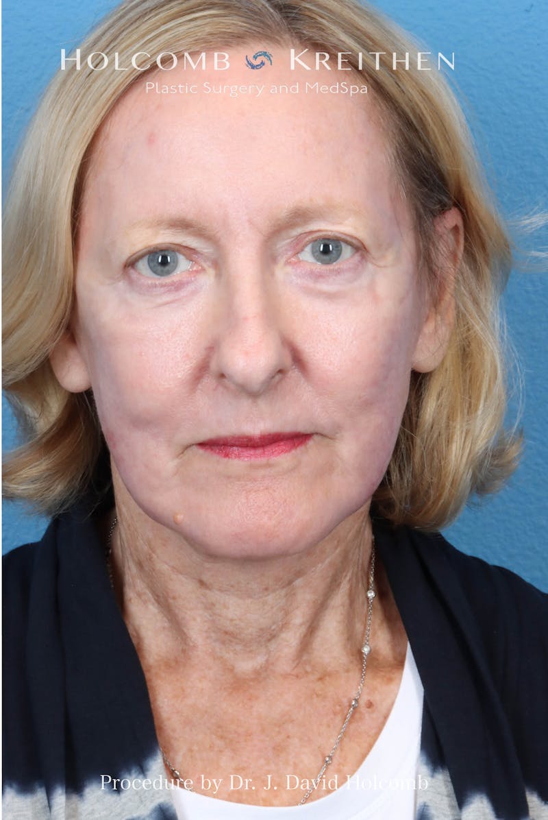 Facelift Before & After Gallery - Patient 410667 - Image 2