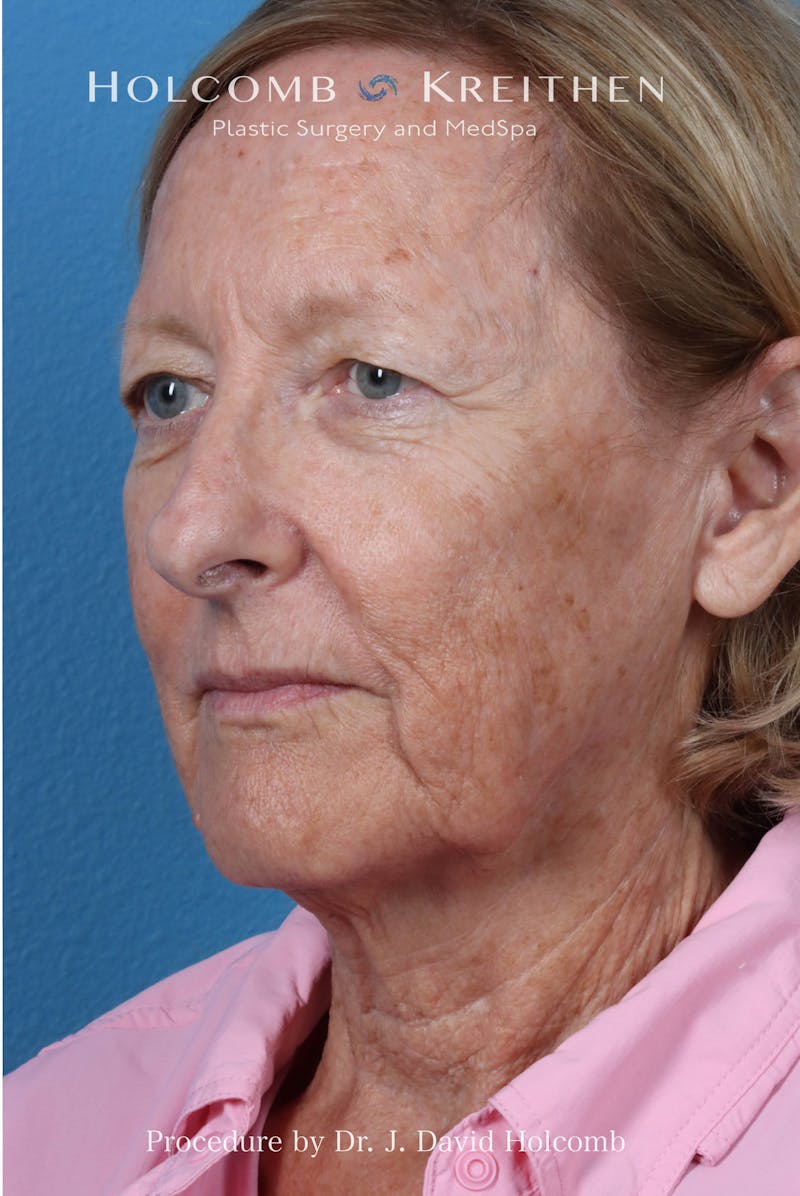 Facelift Before & After Gallery - Patient 410667 - Image 3