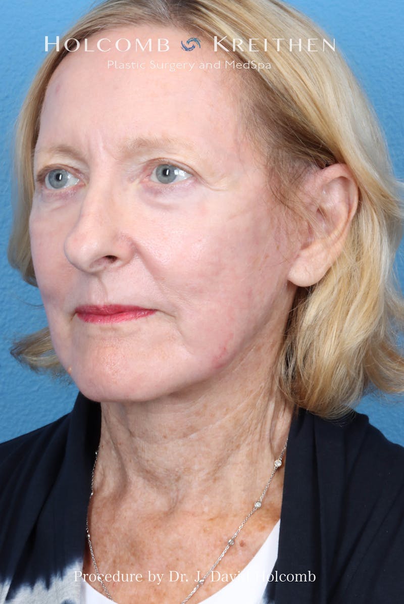 Facelift Before & After Gallery - Patient 410667 - Image 4