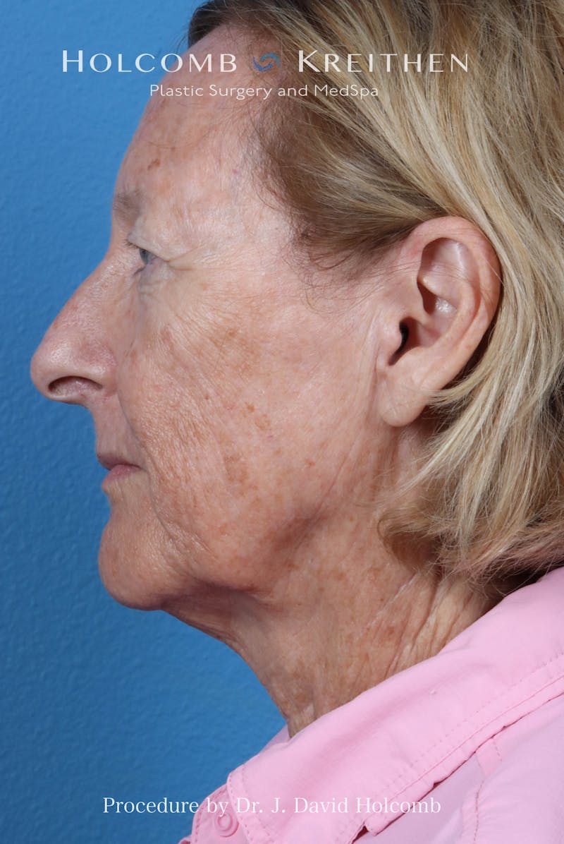 Facelift Before & After Gallery - Patient 410667 - Image 5
