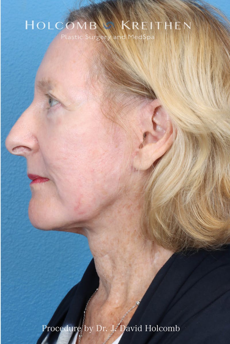 Facelift Before & After Gallery - Patient 410667 - Image 6
