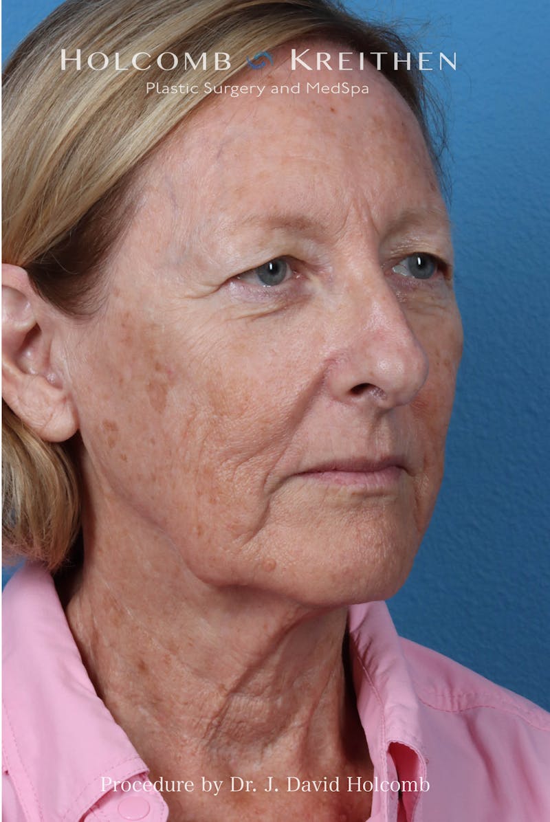 Facelift Before & After Gallery - Patient 410667 - Image 7