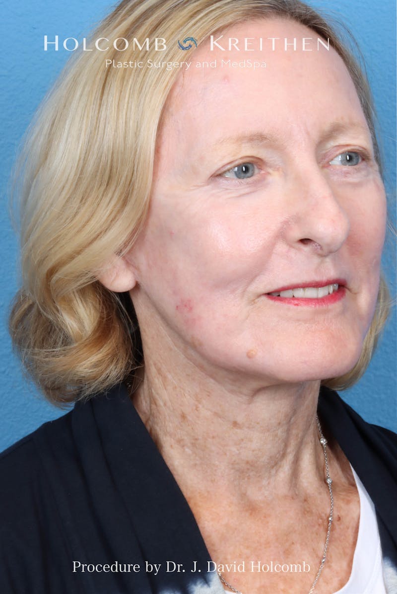 Facelift Before & After Gallery - Patient 410667 - Image 8
