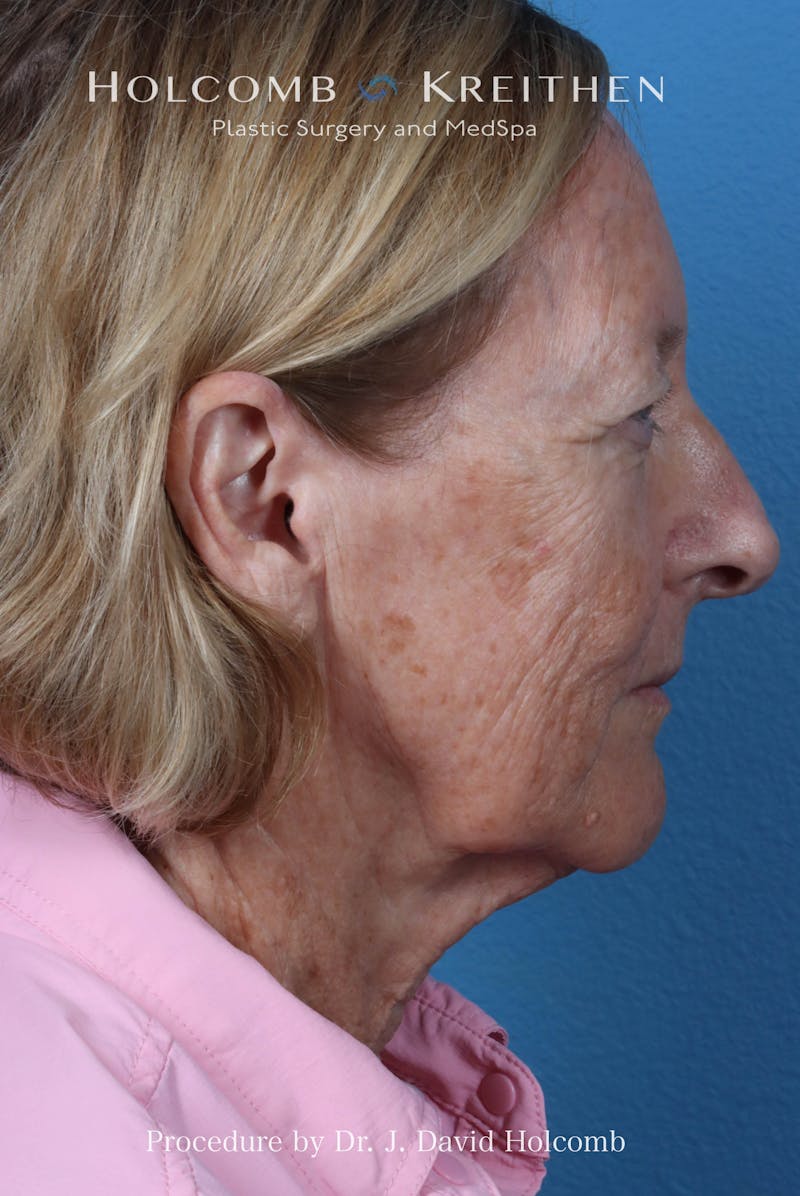 Facelift Before & After Gallery - Patient 410667 - Image 9