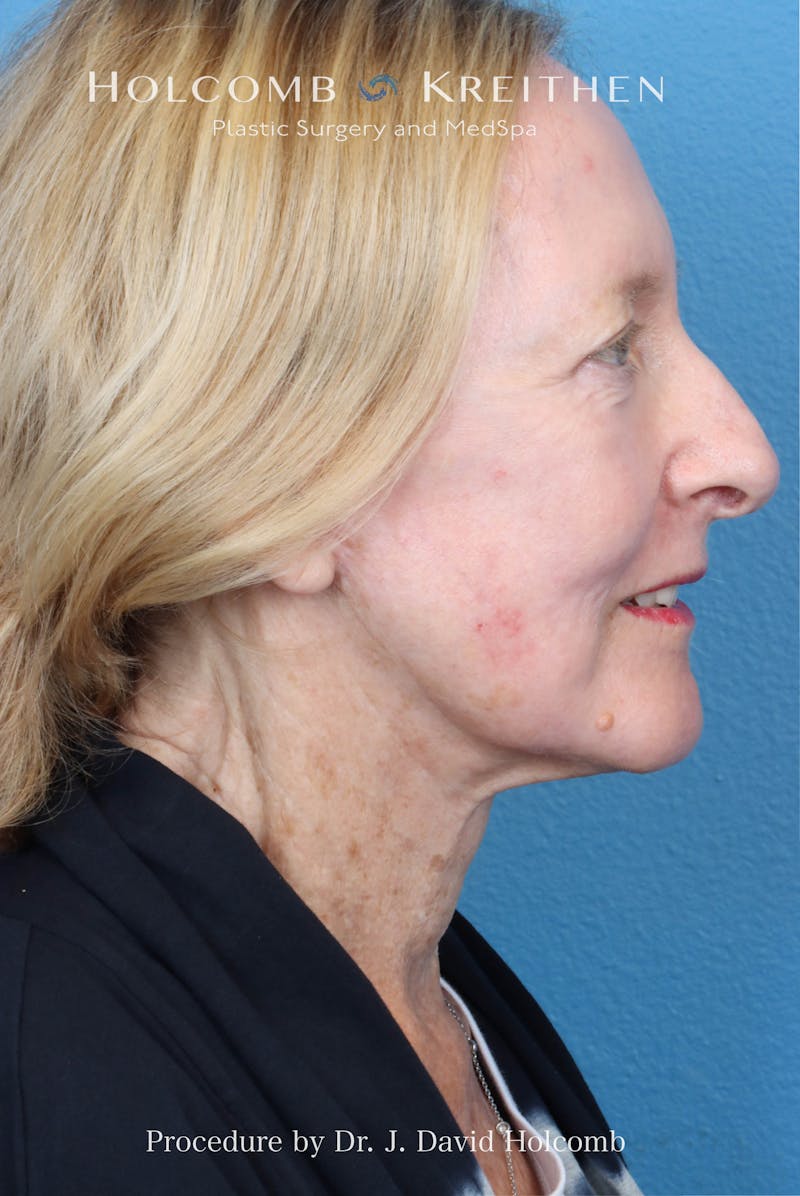 Facelift Before & After Gallery - Patient 410667 - Image 10
