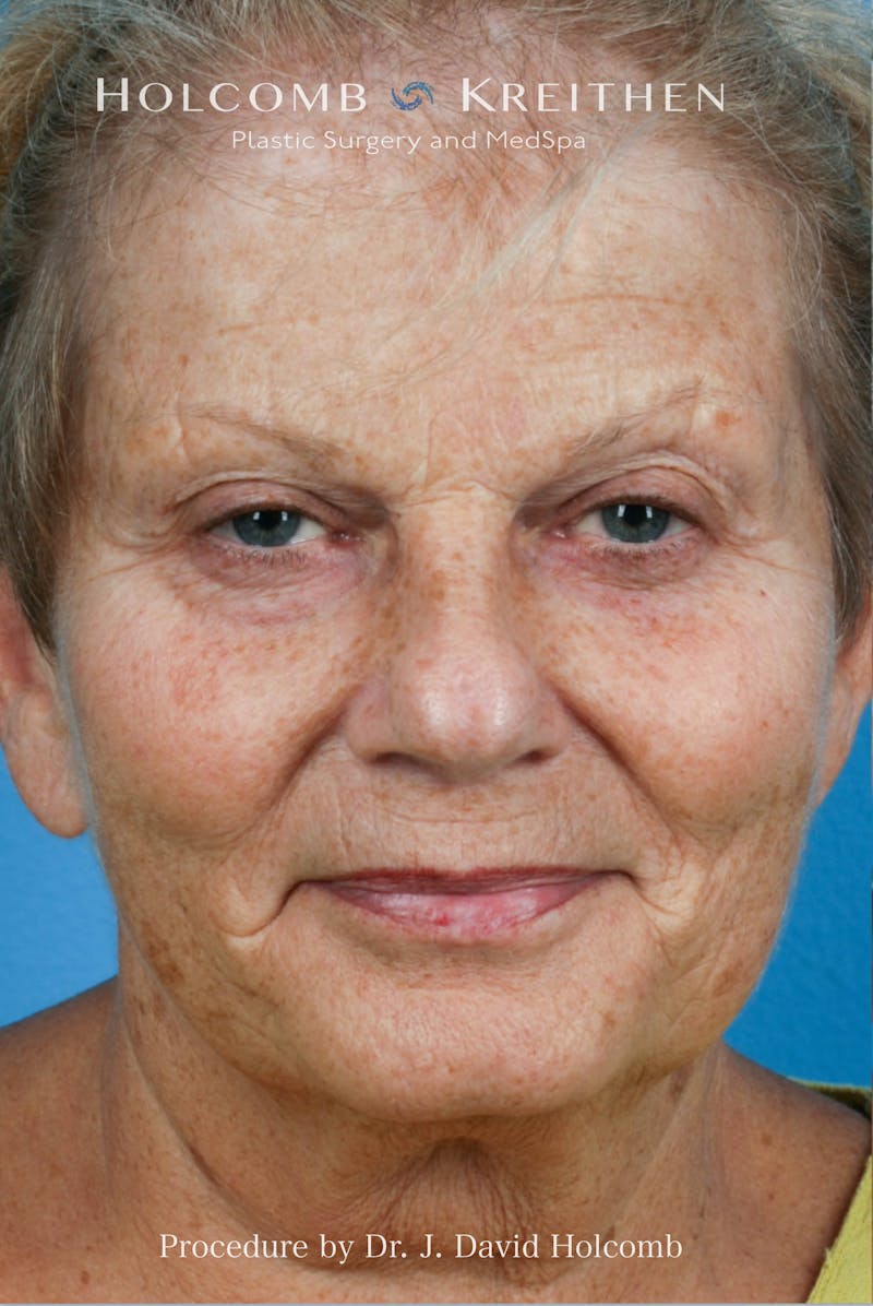 Facelift Before & After Gallery - Patient 707332 - Image 1