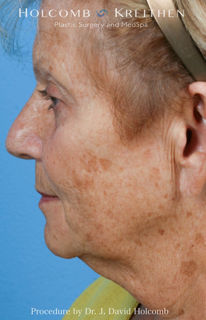 Facelift Before & After Gallery - Patient 707332 - Image 3