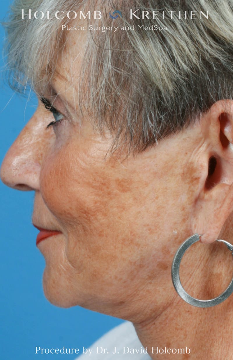Facelift Before & After Gallery - Patient 707332 - Image 4
