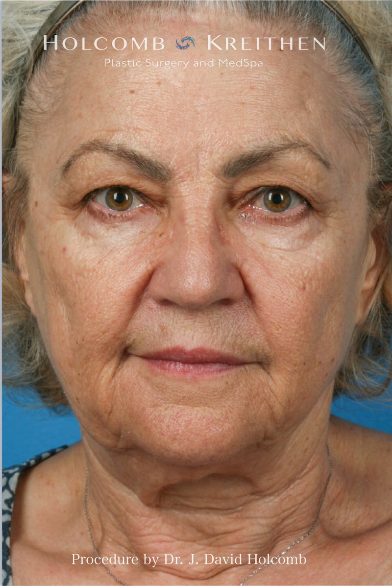 Facelift Before & After Gallery - Patient 291416 - Image 1