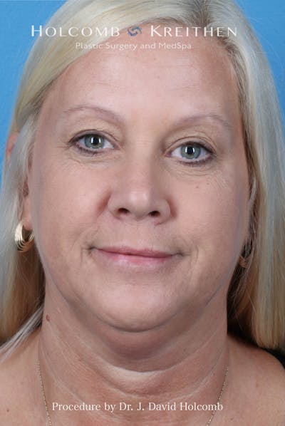 Facelift Before & After Gallery - Patient 975494 - Image 1