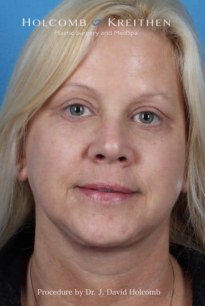 Facelift Before & After Gallery - Patient 975494 - Image 2