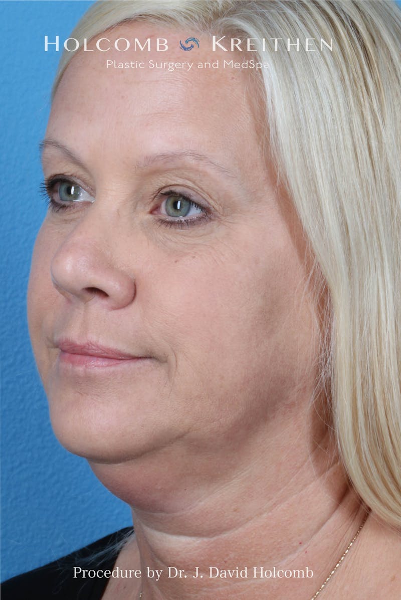 Facelift Before & After Gallery - Patient 975494 - Image 3