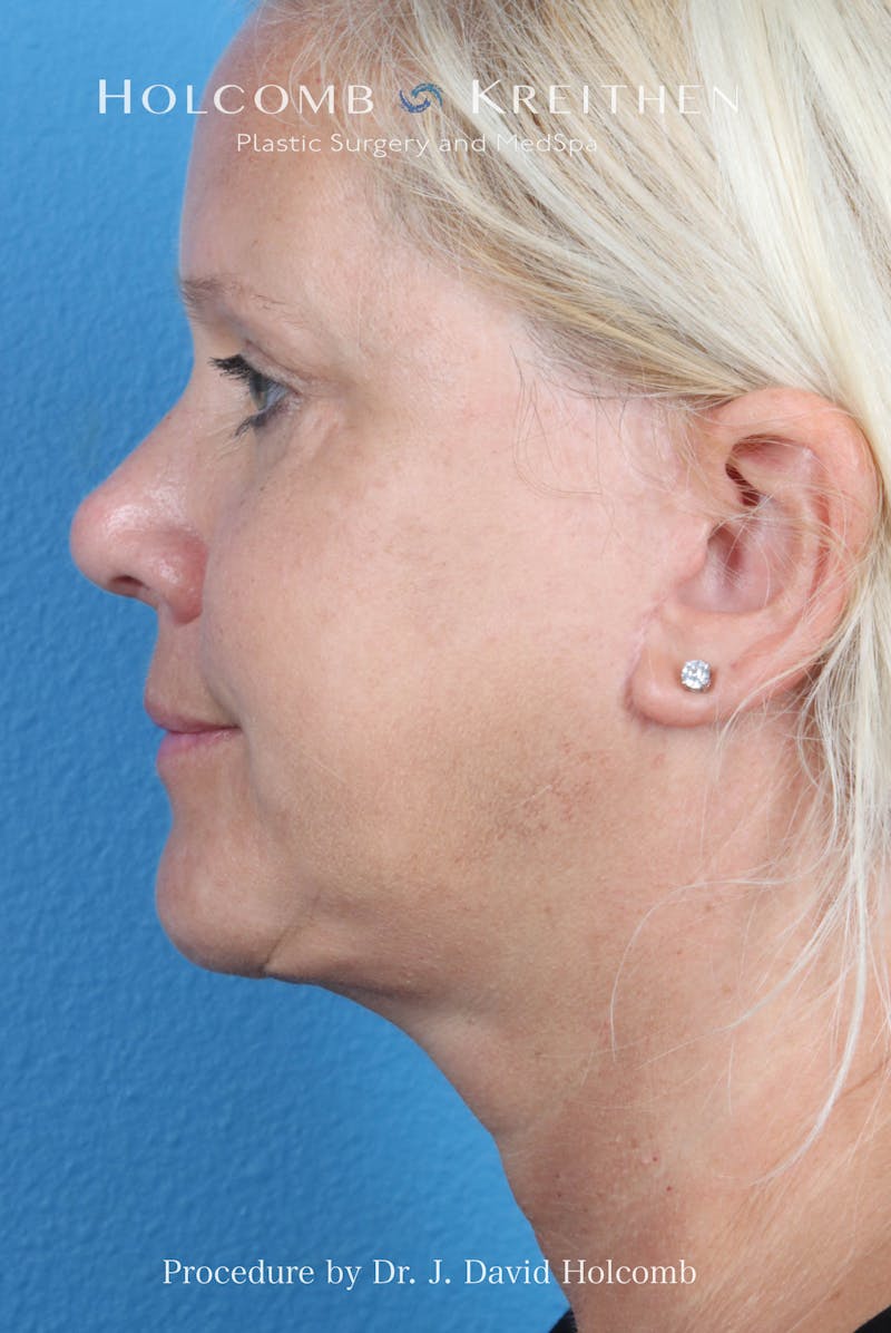 Facelift Before & After Gallery - Patient 975494 - Image 5