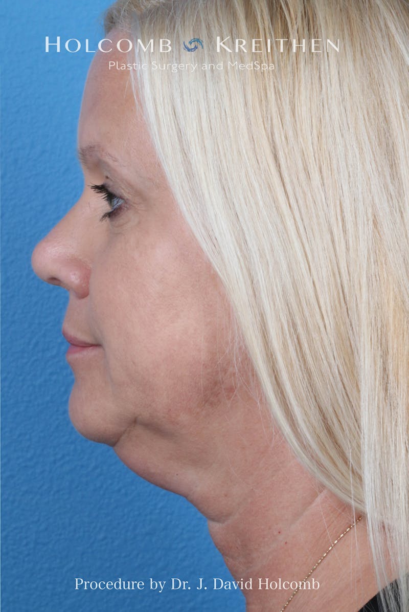 Facelift Before & After Gallery - Patient 975494 - Image 6