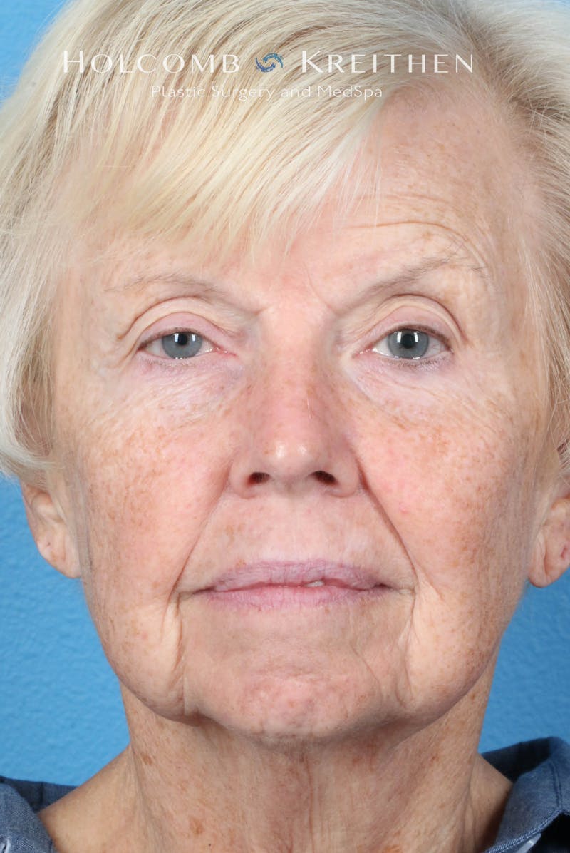 Facelift Before & After Gallery - Patient 153746 - Image 1