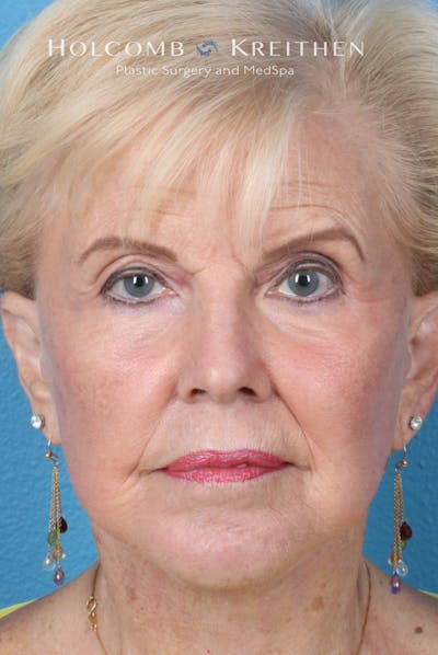 Facelift Before & After Gallery - Patient 153746 - Image 2
