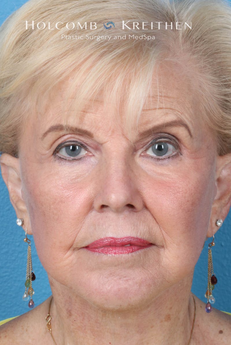 Facelift Before & After Gallery - Patient 153746 - Image 2