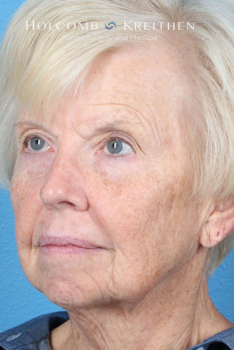 Facelift Before & After Gallery - Patient 153746 - Image 3