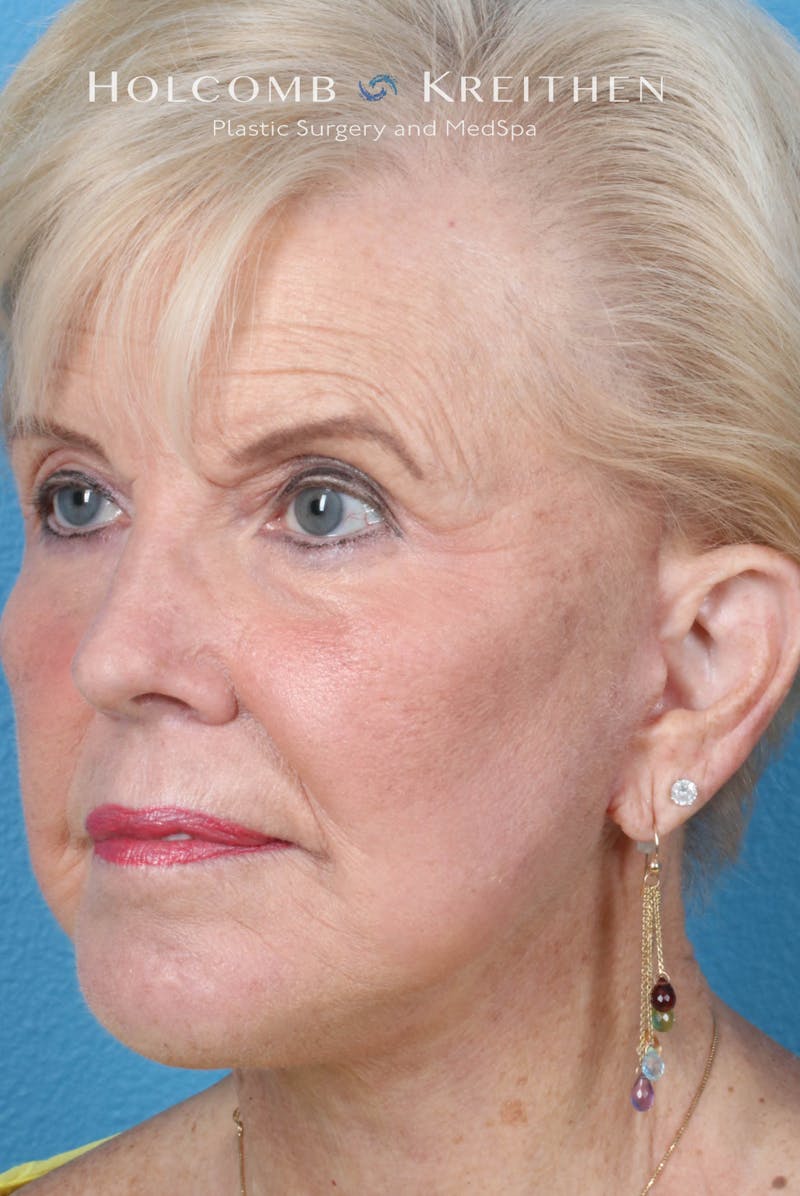 Facelift Before & After Gallery - Patient 153746 - Image 4