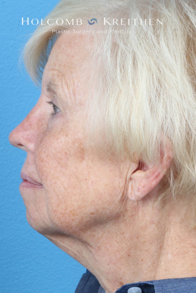 Facelift Before & After Gallery - Patient 153746 - Image 5