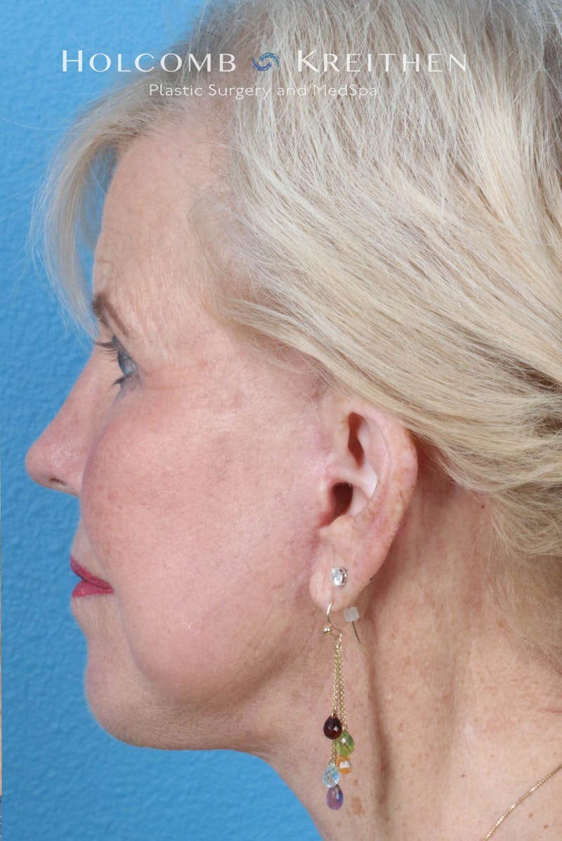 Facelift Before & After Gallery - Patient 153746 - Image 6