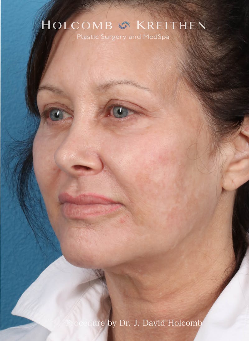 Facelift Before & After Gallery - Patient 126827 - Image 3