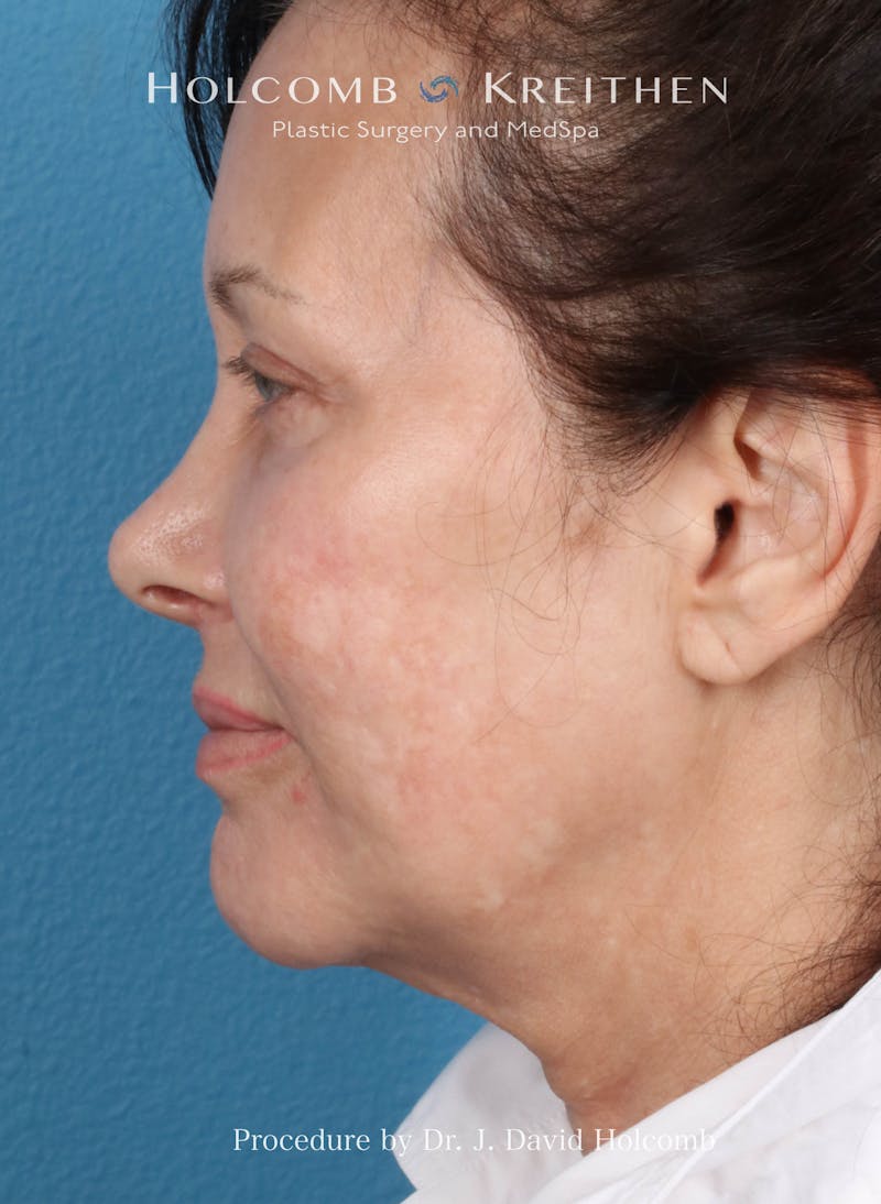 Facelift Before & After Gallery - Patient 126827 - Image 5