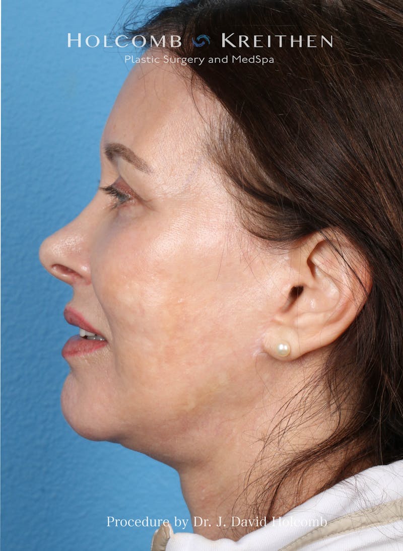 Facelift Before & After Gallery - Patient 126827 - Image 6
