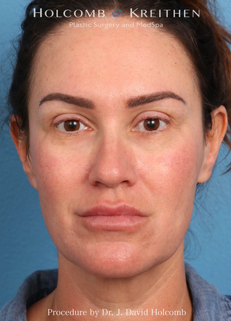 Facelift Before & After Gallery - Patient 162154 - Image 1