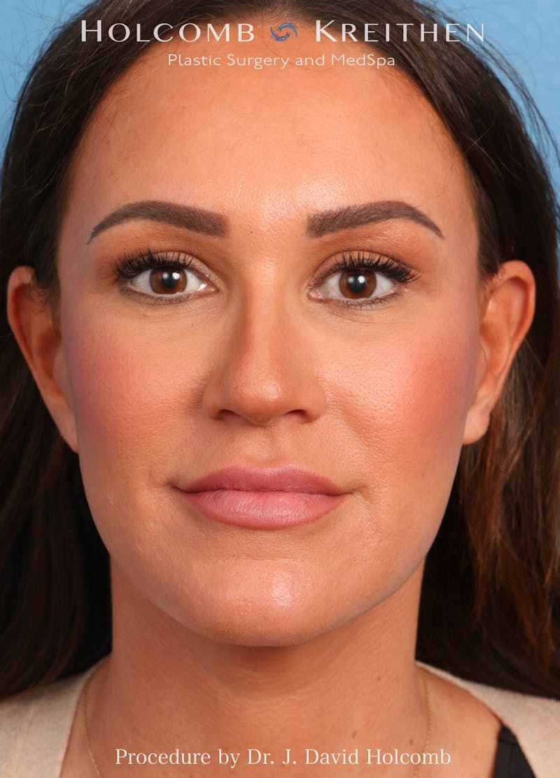 Facelift Before & After Gallery - Patient 162154 - Image 2