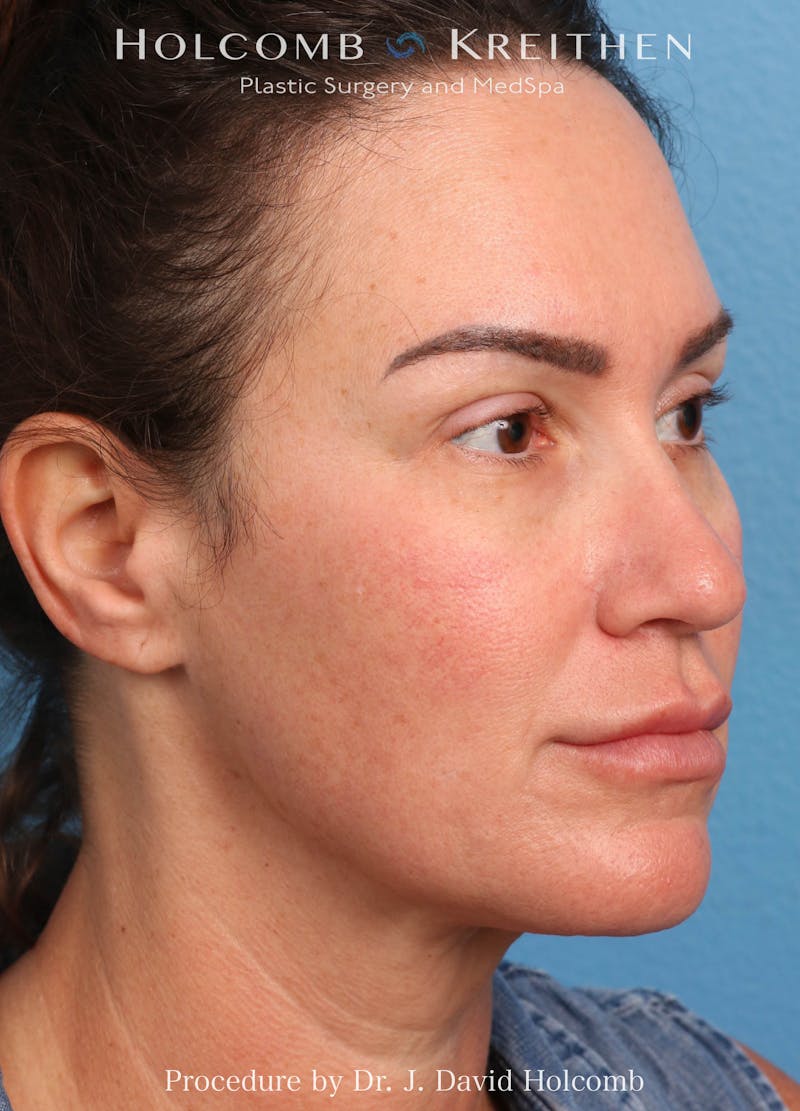 Facelift Before & After Gallery - Patient 162154 - Image 3