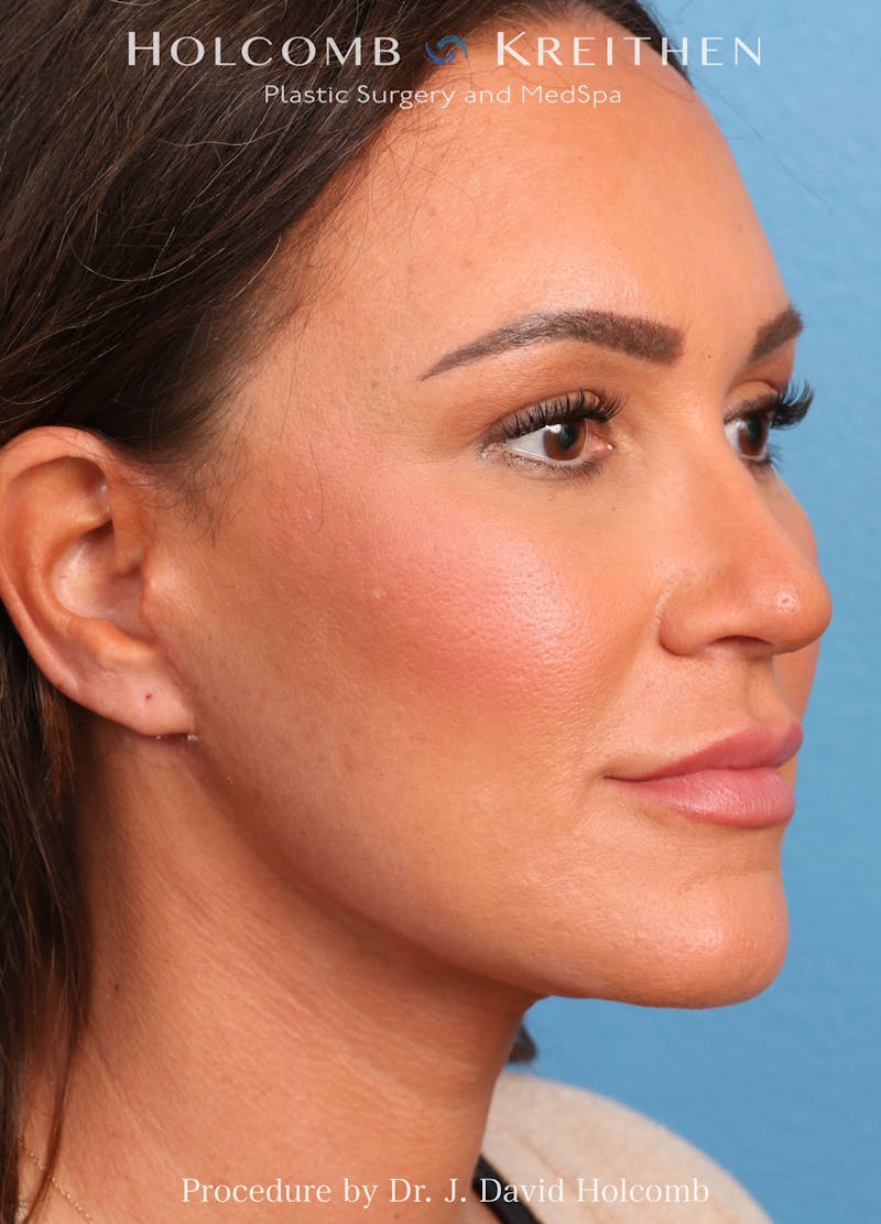 Facelift Before & After Gallery - Patient 162154 - Image 4
