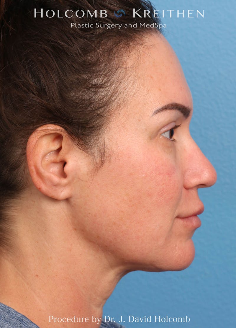 Facelift Before & After Gallery - Patient 162154 - Image 5