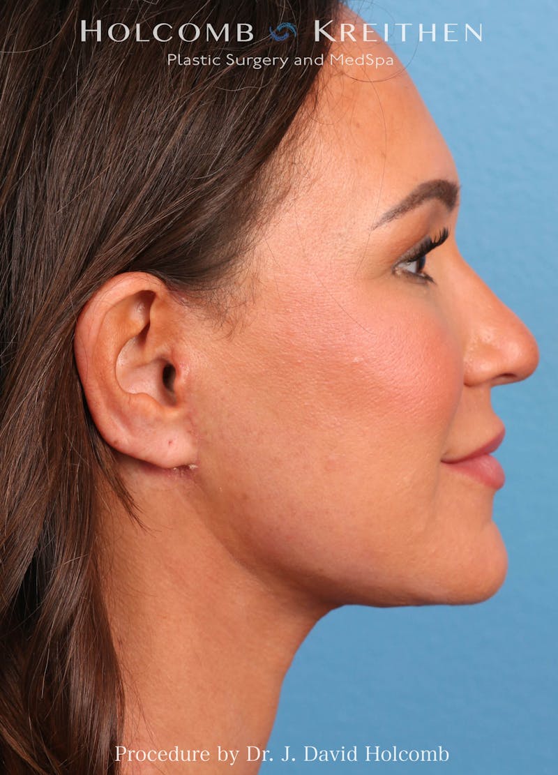 Facelift Before & After Gallery - Patient 162154 - Image 6