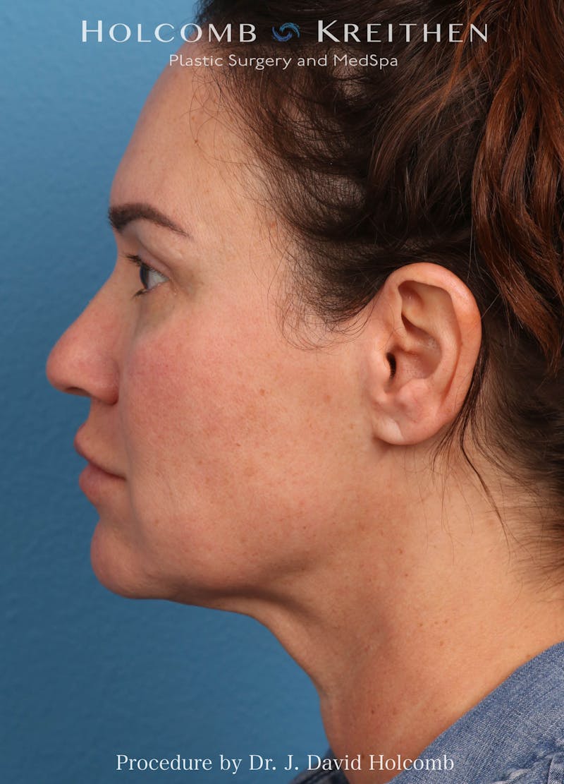 Facelift Before & After Gallery - Patient 162154 - Image 7