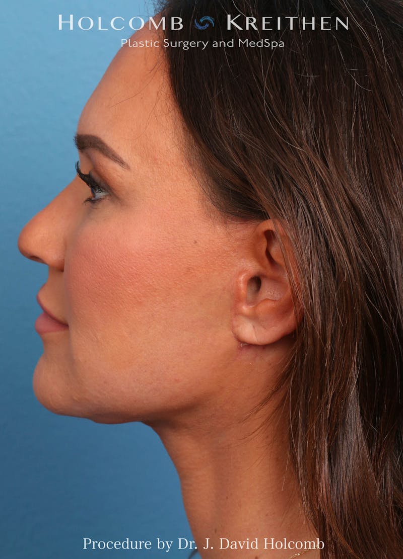 Facelift Before & After Gallery - Patient 162154 - Image 8